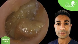 1323  Huge Chunks of Ear Wax Removed [upl. by Althea]