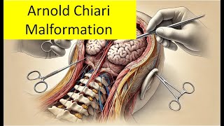 Arnold Chiari Malformation [upl. by Nepean]