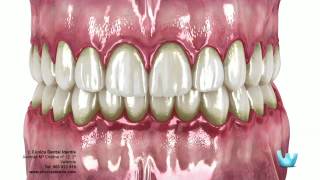 La enfermedad periodontal Gingivitis y Periodontitis [upl. by Gerhard]