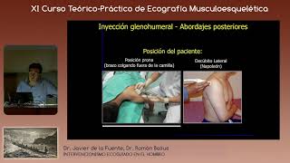 2019 Infiltraciones glenohumerales ecoguiadas en la capsulitis retráctil de hombro [upl. by Deonne]