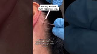 Skin Tag Removal With Radiofrequency  Quick amp Safe Treatment DRMEDISPA [upl. by Heron]