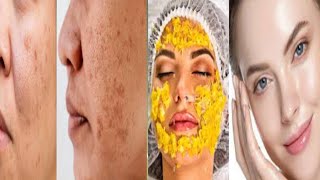 Black ampBrown spot Acne Scars amp Hyperpigmentation Removal Face Mask [upl. by Aiuqet980]