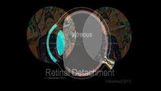 Retinal Detachment [upl. by Behn644]