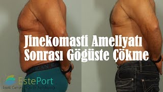 Jinekomasti Ameliyatı Sonrası Çöküntü [upl. by Relyuc607]