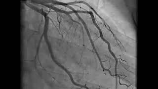 Coronary Angiography  NEJM [upl. by Nev]