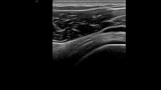 Subacromialsubdeltoid bursa ultrasound [upl. by Ahseel803]