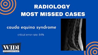 Most Missed Cases Cauda Equina Syndrome [upl. by Ellenwahs]