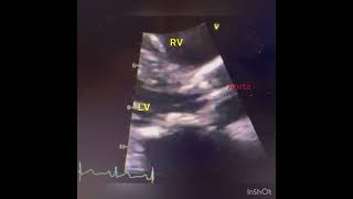 Severe Aortic Stenosis on Echo [upl. by Dougal]