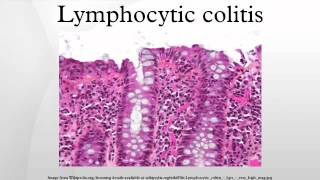 Lymphocytic colitis [upl. by Calley]