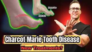 Charcot Marie Tooth Disease  Symptoms amp NEW Treatments 2024 [upl. by Eniladam242]