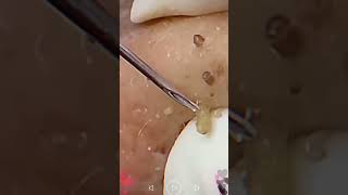 Skincare  Blackheads Removal 182 skincare skincare blackheads blackheads [upl. by Wolff]