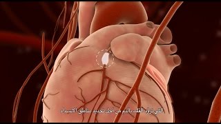 Percutaneous Coronary Intervention PCI [upl. by Ymerrej]