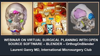 Open source Virtual Surgical Planning Maxillofacial Head amp neck surgery OrthogOnBlender  Blender [upl. by Brigitta]