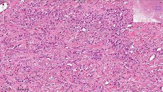 Lobular Carcinoma Breast  Histopathology [upl. by Namyac572]