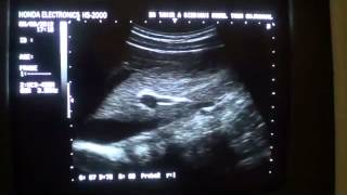 ultrasound scanning techniques GALL BLADDER [upl. by Faustine]