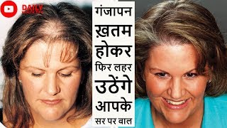 गंजेपन से पेरशान हैं तो अपनाएं ये घरेलू उपाय  Home Remedies To Cure Baldness Effectively [upl. by Lardner498]