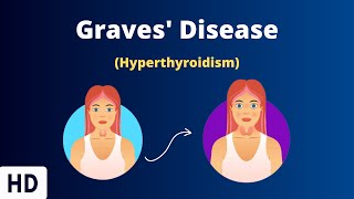 Graves Disease Everything You Need To Know [upl. by Galang]