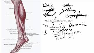 Plantar Fasciitis Is Not A Foot Problem [upl. by Asir709]