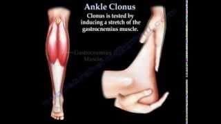 Ankle Clonus  Everything You Need To Know  Dr Nabil Ebraheim [upl. by Dragon27]