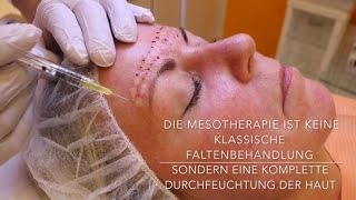 Mesotherapie mit Hyaluronsäure  Behandlung Vorher Nachher [upl. by Kenley]