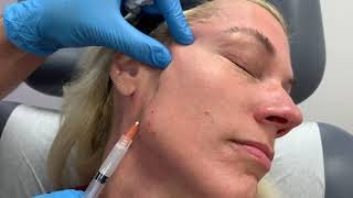 Panfacial rejuvenation using Sculptra and Restylane Defyne by Dr Shaun Patel in Miami Fl [upl. by Kela663]