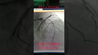 AngioplastyPTCA to LAD  coronary Stenting  Single Vessel disease alliedhealthsciences [upl. by Warren]