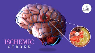 Ischemic Stroke Causes Symptoms Treatment amp Prevention  CARE Hospitals [upl. by Lisa]