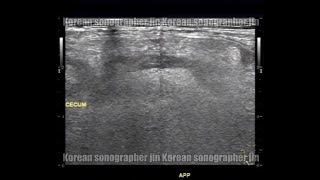 Case3 Appendicitis sonography ultrasound  충수염 초음파 진단사례3 [upl. by Nalda]