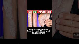 psoriasis treatment in Hindi [upl. by Ydnih]