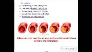 Higher Human Biology  Unit 2 7a Cardiovascular Disease [upl. by Derag]