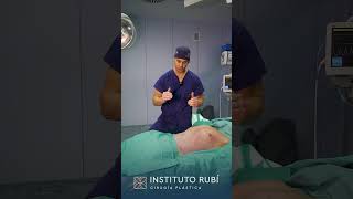 Cirugía plástica de lipoescultura con marcación abdominal [upl. by Addia88]