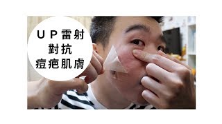 三重知名皮膚科治療！治療痘疤凹洞：UP雷射心得 （上集）  Bolow 菠蘿 [upl. by Cort]