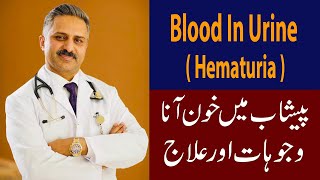 Blood in Urine  Hematuria  Causes amp Treatment [upl. by Eedna3]