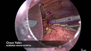 Laparoscopic Proximal Gastrectomy with Double Tract Anastomosis [upl. by Ardnod]