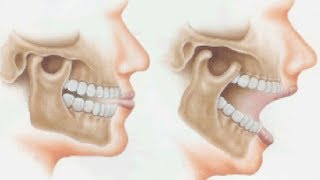 Orthotropic Treatment of Jaw JointTemporomandibular Disorder TMD by Dr Mike Mew [upl. by Carce]