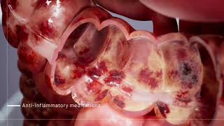 Ulcerative Colitis Medications  3D Medical Animation  Pixeldust Studios [upl. by Inahpit]