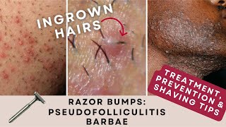 Razor Bumps Pseudofolliculitis Barbae  Prevention amp Treatment [upl. by Adamsun]