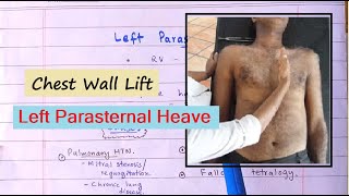 Clinical Sign Of Right Ventricular Hypertrophy  Left Parasternal Heave How To Palpate [upl. by Camala]