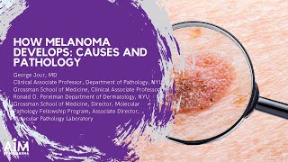 How Melanoma Develops Causes and Pathology [upl. by Garrek]