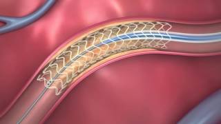 FDAApproved Dissolving Heart Stent  How It Works [upl. by Aloisius]