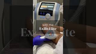 Sagging Arms Begone with Exilis Elite [upl. by Ahsinnor419]