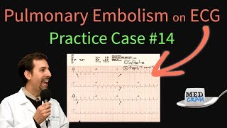 ECG Findings in Pulmonary Embolism  EKG Changes With an Acute PE [upl. by Canice]