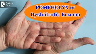 DYSHIDROTIC ECZEMA OR POMPHOLYX CausesSymptoms amp Treatment  Dr Aruna Prasad  Doctors Circle [upl. by Artus626]