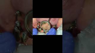 Proper Alveoloplasty  No gum shrinkage even after 2 years  Mandible full implants [upl. by Charbonneau]