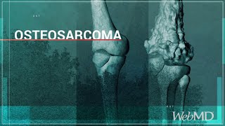 Basics Osteosarcoma  WebMD [upl. by Dannica]