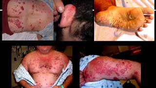 Stelara Side Effects  Stelara causes drug induced psoriasis  Biologic problems [upl. by Akemehs]