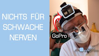 Zahnarzt filmt Weisheitszahn OP mit GoPro Vollnarkose [upl. by Laurent725]