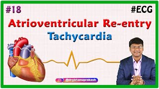 18 Atrioventricular Reentry Tachycardia amp Atrioventricular Nodal Reentrant Tachycardia [upl. by Mallissa]