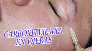 Eliminar ojeras con Carboxiterapia tratamiento medico [upl. by Netaf]