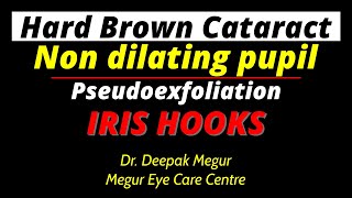 Pseudoexfoliation amp Non dilated pupil  Iris Hooks use for dilatation  Dr Deepak Megur [upl. by Irene]